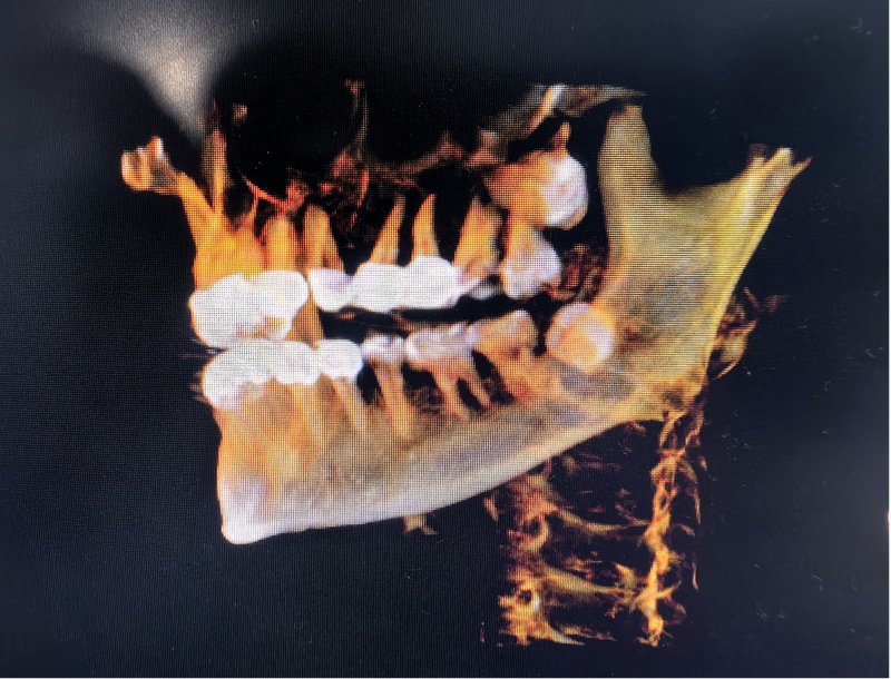 術后：鄰牙、神經、鼻腔及上頜竇粘膜均無損傷。